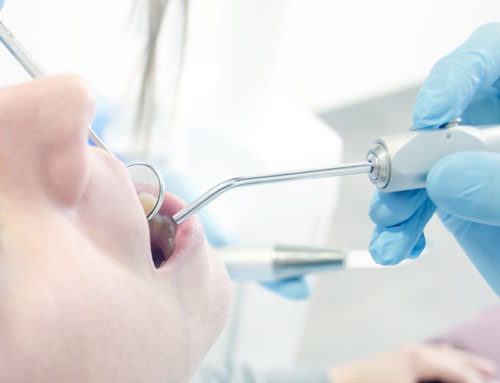 インプラント・治療イメージ